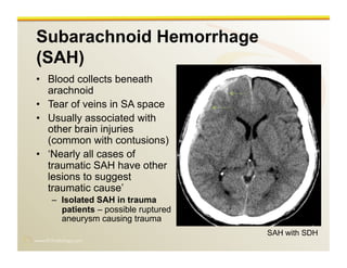 www.RiTradiology.com	

Subarachnoid Hemorrhage
(SAH)
•  Blood collects beneath
arachnoid
•  Tear of veins in SA space
•  Usually associated with
other brain injuries
(common with contusions)
•  ‘Nearly all cases of
traumatic SAH have other
lesions to suggest
traumatic cause’
–  Isolated SAH in trauma
patients – possible ruptured
aneurysm causing trauma
SAH with SDH
 