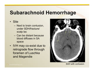 www.RiTradiology.com	

Subarachnoid Hemorrhage
•  Site
–  Next to brain contusion,
under SDH/fracture/
scalp lac
–  Can be distant because
blood diffuses in SA
space
•  IVH may co-exist due to
retrograde flow through
foramen of Luschka
and Magendie
SAH with contusion
 