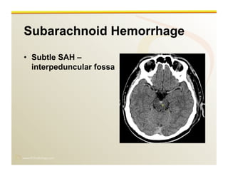 www.RiTradiology.com	

Subarachnoid Hemorrhage
•  Subtle SAH –
interpeduncular fossa
 