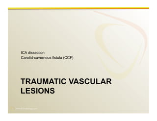 www.RiTradiology.com	

TRAUMATIC VASCULAR
LESIONS
ICA dissection
Carotid-cavernous fistula (CCF)
 