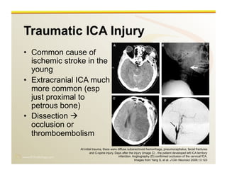 www.RiTradiology.com	

Traumatic ICA Injury
•  Common cause of
ischemic stroke in the
young
•  Extracranial ICA much
more common (esp
just proximal to
petrous bone)
•  Dissection 
occlusion or
thromboembolism
At initial trauma, there were diffuse subarachnoid hemorrhage, pneumocephalus, facial fractures
and C-spine injury. Days after the injury (image C) , the patient developed left ICA territory
infarction. Angiiography (D) confirmed occlusion of the cervical ICA.
Images from Yang S, et al. J Clin Neurosci 2006;13:123
 
