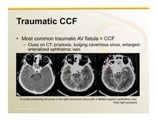 www.RiTradiology.com	

Traumatic CCF
•  Most common traumatic AV fistula = CCF
–  Clues on CT: proptosis, bulging cavernous sinus, enlarged-
arterialized ophthalmic vein
A vividly enhancing structure in the right cavernous sinus with a dilated superior ophthalmic vein.
Note right proptosis
 