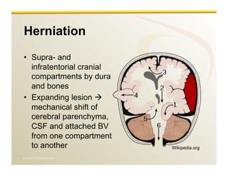 www.RiTradiology.com	

Herniation
•  Supra- and
infratentorial cranial
compartments by dura
and bones
•  Expanding lesion 
mechanical shift of
cerebral parenchyma,
CSF and attached BV
from one compartment
to another Wikipedia.org
 