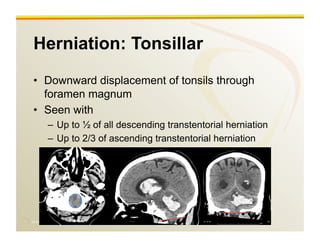 www.RiTradiology.com	

Herniation: Tonsillar
•  Downward displacement of tonsils through
foramen magnum
•  Seen with
–  Up to ½ of all descending transtentorial herniation
–  Up to 2/3 of ascending transtentorial herniation
 