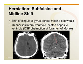 www.RiTradiology.com	

Herniation: Subfalcine and
Midline Shift
•  Shift of cingulate gyrus across midline below falx
•  Thinner ipsilateral ventricle, dilated opposite
ventricle (CSF obstruction at foramen of Monro)
 