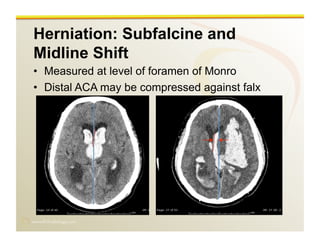 www.RiTradiology.com	

Herniation: Subfalcine and
Midline Shift
•  Measured at level of foramen of Monro
•  Distal ACA may be compressed against falx
 