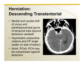 www.RiTradiology.com	

Herniation:
Descending Transtentorial
•  Medial and caudal shift
of uncus and
parahippocampal gyrus
of temporal lobe beyond
tentorium cerebelli
•  Asymmetric prepontine
cisterns and CP angle
(wider on side of lesion)
•  AchA, PCoA, PCA may
be compressed against
tentorium
 