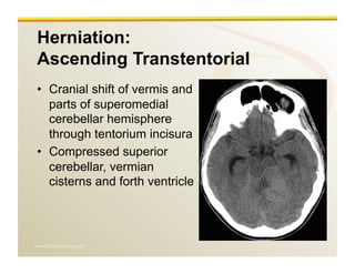 www.RiTradiology.com	

Herniation:
Ascending Transtentorial
•  Cranial shift of vermis and
parts of superomedial
cerebellar hemisphere
through tentorium incisura
•  Compressed superior
cerebellar, vermian
cisterns and forth ventricle
 