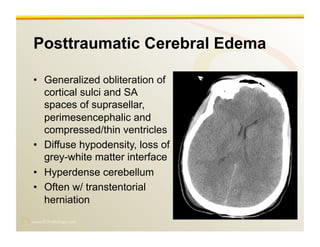 www.RiTradiology.com	

Posttraumatic Cerebral Edema
•  Generalized obliteration of
cortical sulci and SA
spaces of suprasellar,
perimesencephalic and
compressed/thin ventricles
•  Diffuse hypodensity, loss of
grey-white matter interface
•  Hyperdense cerebellum
•  Often w/ transtentorial
herniation
 