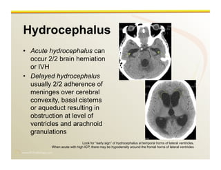www.RiTradiology.com	

Hydrocephalus
•  Acute hydrocephalus can
occur 2/2 brain herniation
or IVH
•  Delayed hydrocephalus
usually 2/2 adherence of
meninges over cerebral
convexity, basal cisterns
or aqueduct resulting in
obstruction at level of
ventricles and arachnoid
granulations
Look for “early sign” of hydrocephalus at temporal horns of lateral ventricles.
When acute with high ICP, there may be hypodensity around the frontal horns of lateral ventricles
 