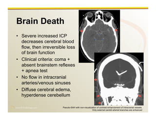 www.RiTradiology.com	

Brain Death
•  Severe increased ICP
decreases cerebral blood
flow, then irreversible loss
of brain function
•  Clinical criteria: coma +
absent brainstem reflexes
+ apnea test
•  No flow in intracranial
arteries/venous sinuses
•  Diffuse cerebral edema,
hyperdense cerebellum
Pseudo-SAH with non-visualization of contrast enhancement of intracranial vessels.
Only external carotid arterial branches are enhanced
 
