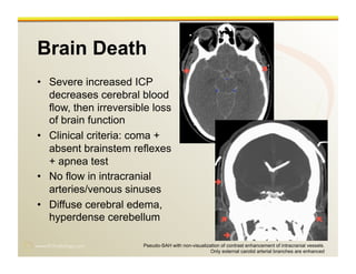 Imaging of Traumatic Brain Injury | PPT