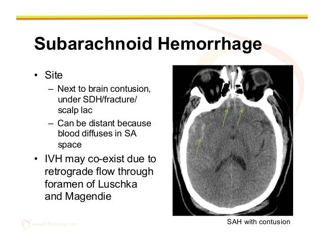 subarachnoid hemorrhage subarachnoid hemorrhage