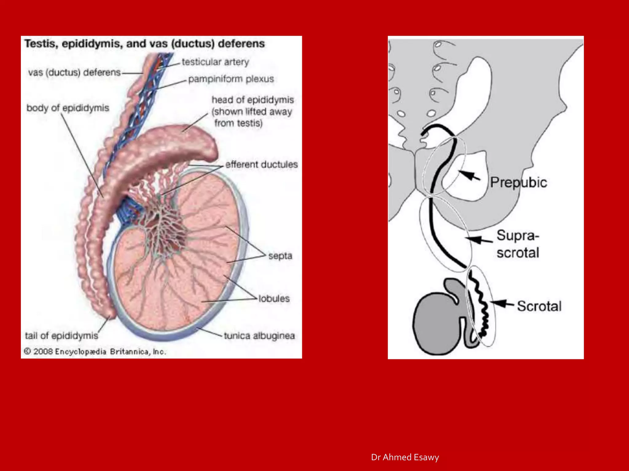 Funicularitis Imaging vastitis differentitis funiculitis seminal vesiculitis Dr Ahmed ...
