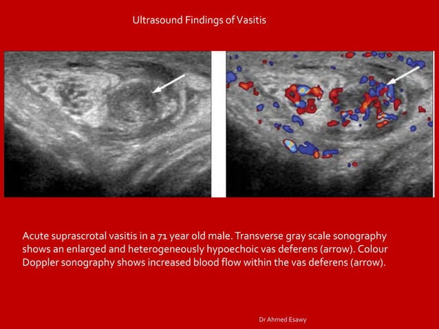 Funicularitis Imaging vastitis differentitis funiculitis seminal vesiculitis Dr Ahmed ...