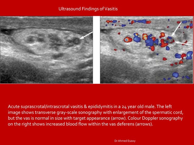 Funicularitis Imaging vastitis differentitis funiculitis seminal vesiculitis Dr Ahmed ...