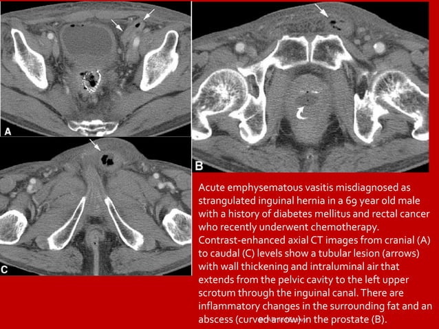 Funicularitis Imaging vastitis differentitis funiculitis seminal vesiculitis Dr Ahmed ...
