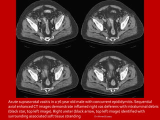 Funicularitis Imaging vastitis differentitis funiculitis seminal vesiculitis Dr Ahmed ...