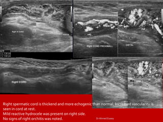 Imaging vastitis differentitis funiculitis seminal vesiculitis Dr Ahmed ...
