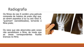 Radiografia
Os filmes de raio X contêm uma película
composta de haletos de prata (Ag) que,
ao serem expostos à luz ou aos raios X,
“queimam” (sensibilizados), tornando o
filme preto;
Os raios que são absorvidos pelo corpo
não sensibilizam o filme, de modo que
as áreas correspondentes ficarão
brancas no filme.
 