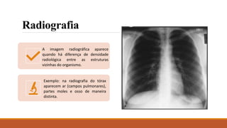 Radiografia
A imagem radiográfica aparece
quando há diferença de densidade
radiológica entre as estruturas
vizinhas do organismo.
Exemplo: na radiografia do tórax
aparecem ar (campos pulmonares),
partes moles e osso de maneira
distinta.
 