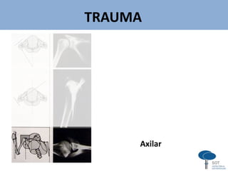 TRAUMA
Axilar
v
 