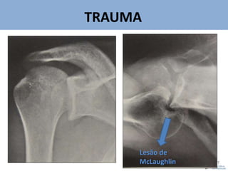 TRAUMA
v
Lesão de
McLaughlin
 