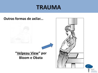 TRAUMA
v
Outras formas de axilar...
“Velpeau View” por
Bloom e Obata
 