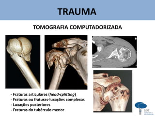 TRAUMA
v
TOMOGRAFIA COMPUTADORIZADA
- Fraturas articulares (head-splitting)
- Fraturas ou fraturas-luxações complexas
- Luxações posteriores
- Fraturas do tubérculo menor
 