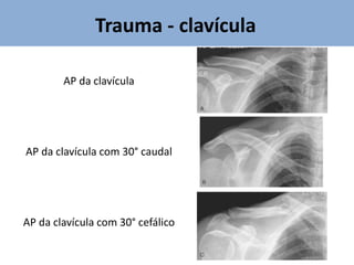 Trauma - clavícula
AP da clavícula
AP da clavícula com 30° caudal
AP da clavícula com 30° cefálico
 