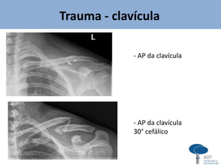 Trauma - clavícula
- AP da clavícula
- AP da clavícula
30° cefálico
 
