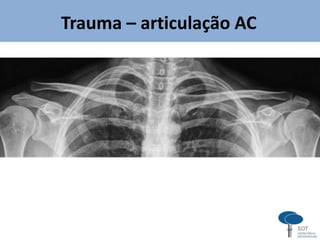 Trauma – articulação AC
 