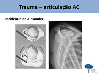 Incidência de Alexander
Trauma – articulação AC
 