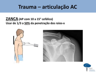 Trauma – articulação AC
ZANCA (AP com 10 a 15° cefálico)
Usar de 1/3 a 50% da penetração dos raios-x
 