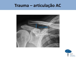 1.1 a 1.3cm
Trauma – articulação AC
 