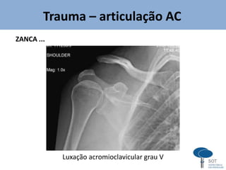 Trauma – articulação AC
ZANCA ...
Luxação acromioclavicular grau V
 