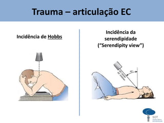 Trauma – articulação EC
Incidência de Hobbs
Incidência da
serendipidade
(“Serendipity view”)
 