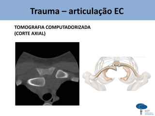 Trauma – articulação EC
TOMOGRAFIA COMPUTADORIZADA
(CORTE AXIAL)
 