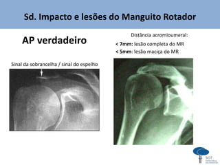 Sd. Impacto e lesões do Manguito Rotador
AP verdadeiro
Distância acromioumeral:
< 7mm: lesão completa do MR
< 5mm: lesão maciça do MR
Sinal da sobrancelha / sinal do espelho
 