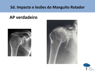 Sd. Impacto e lesões do Manguito Rotador
AP verdadeiro
 