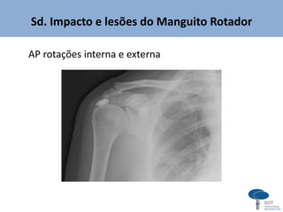 AP rotações interna e externa
Sd. Impacto e lesões do Manguito Rotador
 