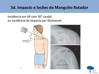 Sd. Impacto e lesões do Manguito Rotador
Incidência em AP com 30° caudal
ou Incidência do Impacto por Rockwood
 
