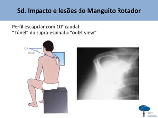 Sd. Impacto e lesões do Manguito Rotador
Perfil escapular com 10° caudal
“Túnel” do supra-espinal = “oulet view”
 