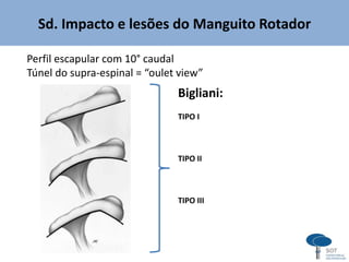 Sd. Impacto e lesões do Manguito Rotador
Perfil escapular com 10° caudal
Túnel do supra-espinal = “oulet view”
Bigliani:
TIPO I
TIPO II
TIPO III
 