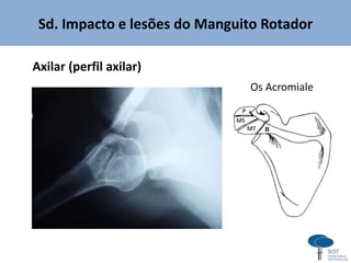 Sd. Impacto e lesões do Manguito Rotador
Axilar (perfil axilar)
B
Os Acromiale
 