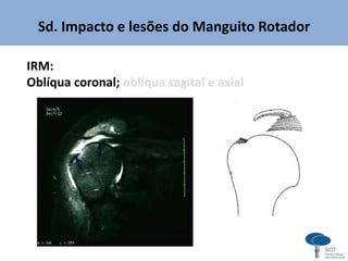 Sd. Impacto e lesões do Manguito Rotador
IRM:
Oblíqua coronal; oblíqua sagital e axial
 