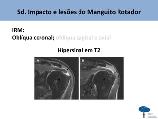 Sd. Impacto e lesões do Manguito Rotador
IRM:
Oblíqua coronal; oblíqua sagital e axial
Hipersinal em T2
 