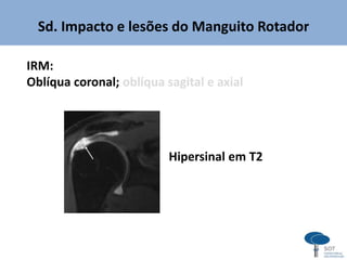 Sd. Impacto e lesões do Manguito Rotador
IRM:
Oblíqua coronal; oblíqua sagital e axial
Hipersinal em T2
 