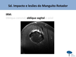 Sd. Impacto e lesões do Manguito Rotador
IRM:
Oblíqua coronal; oblíqua sagital e axial
 