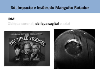 Sd. Impacto e lesões do Manguito Rotador
IRM:
Oblíqua coronal; oblíqua sagital e axial
 